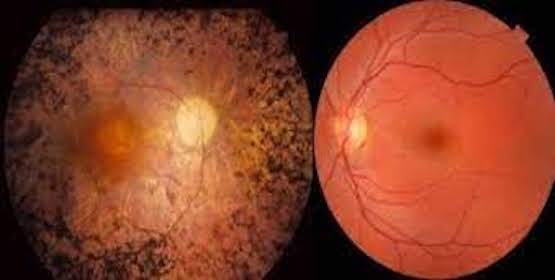Retinografia Colorida